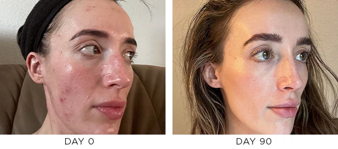 blemish-prone-ba-KC