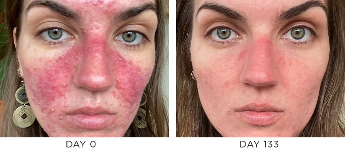 blemish-prone-ba-bm