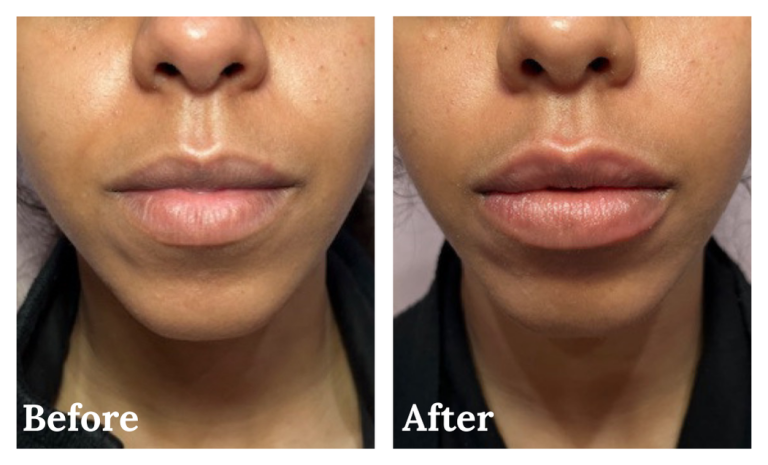 Lip filler