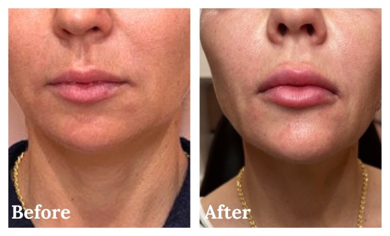 Lip filler