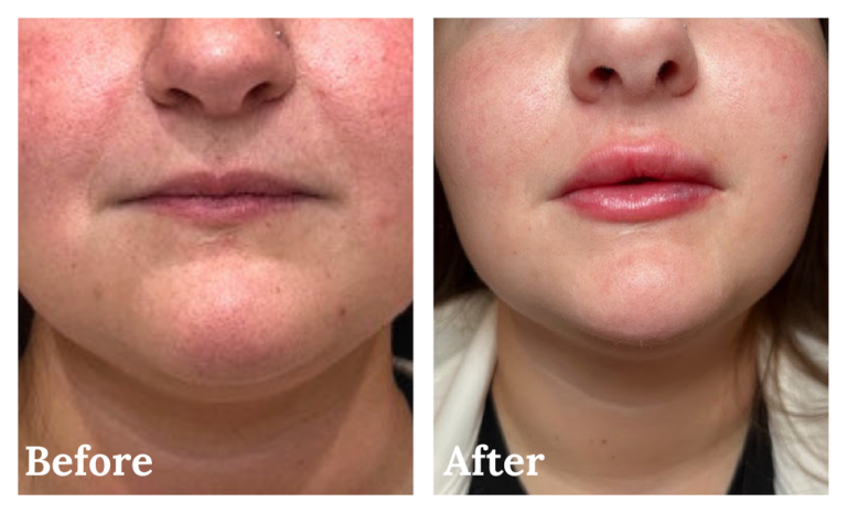 Lip filler