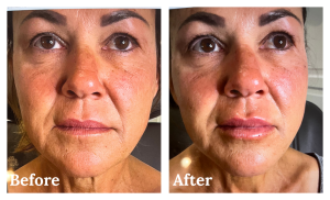 Lip & face/cheek filler