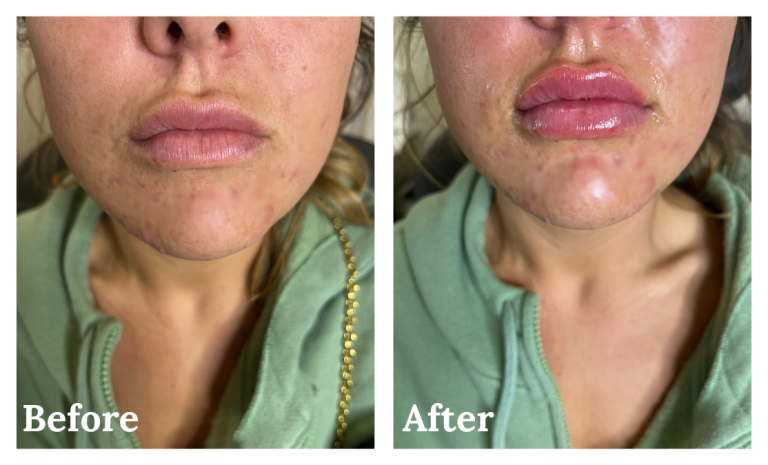 Lip filler