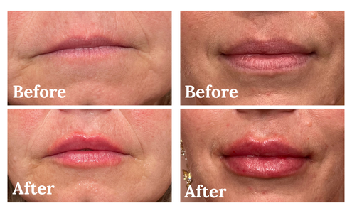 Lip filler (2 befores & afters)