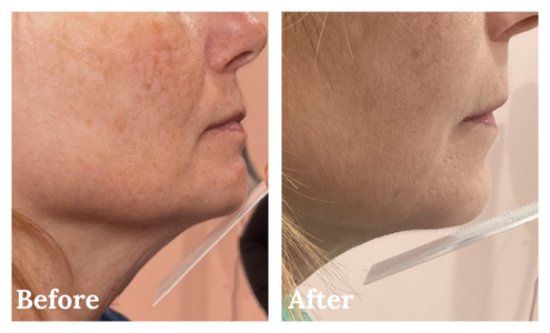Kybella before & after